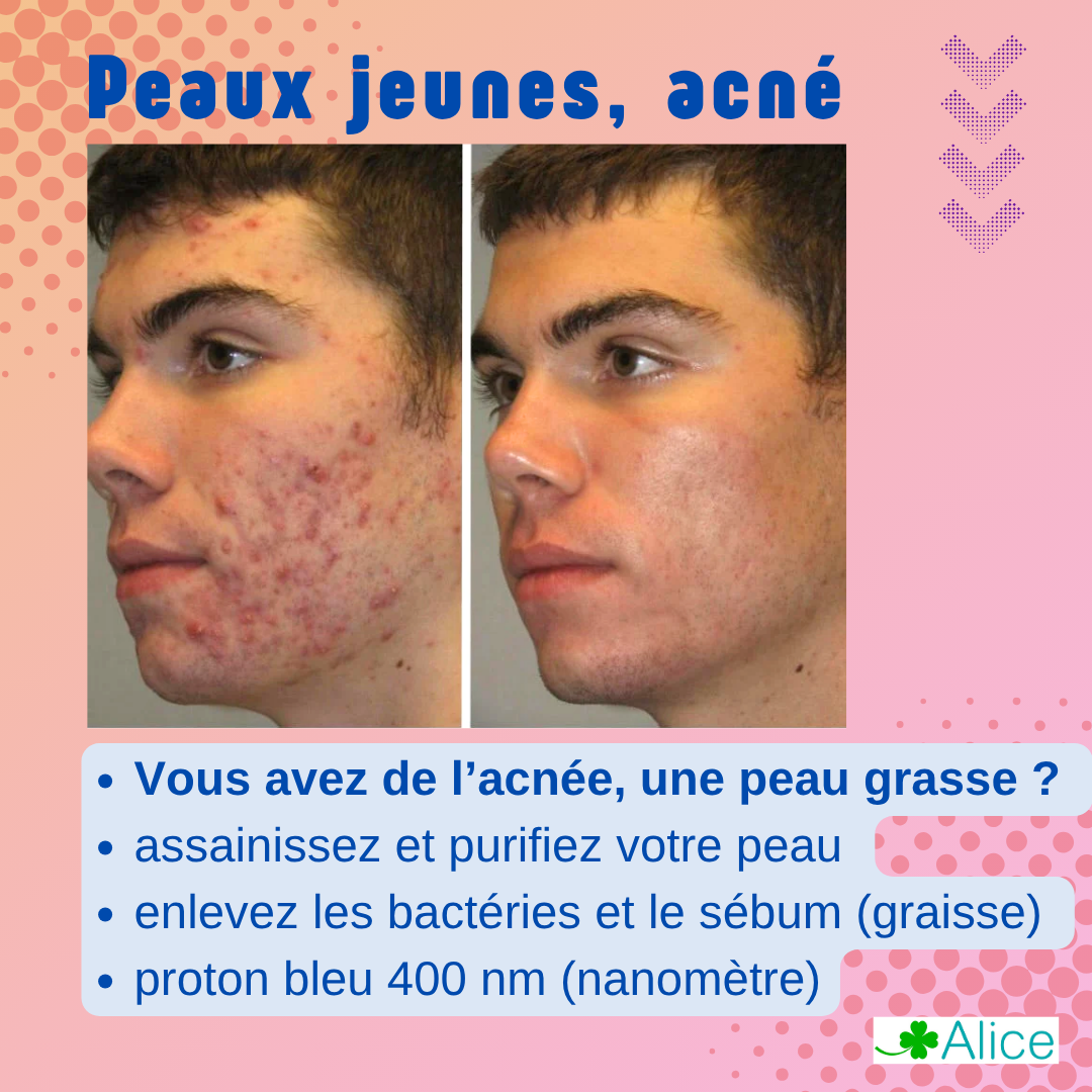 Masque LED Visage et Cou, Anti-Âge Anti-Rides, 4 Couleurs, 300 LED avec Infrarouge, Silicone Médical, pour Peaux a imperfection ou bien anti-age. Cure de 30 jours, repulpe, luminothérapie, – Image 4